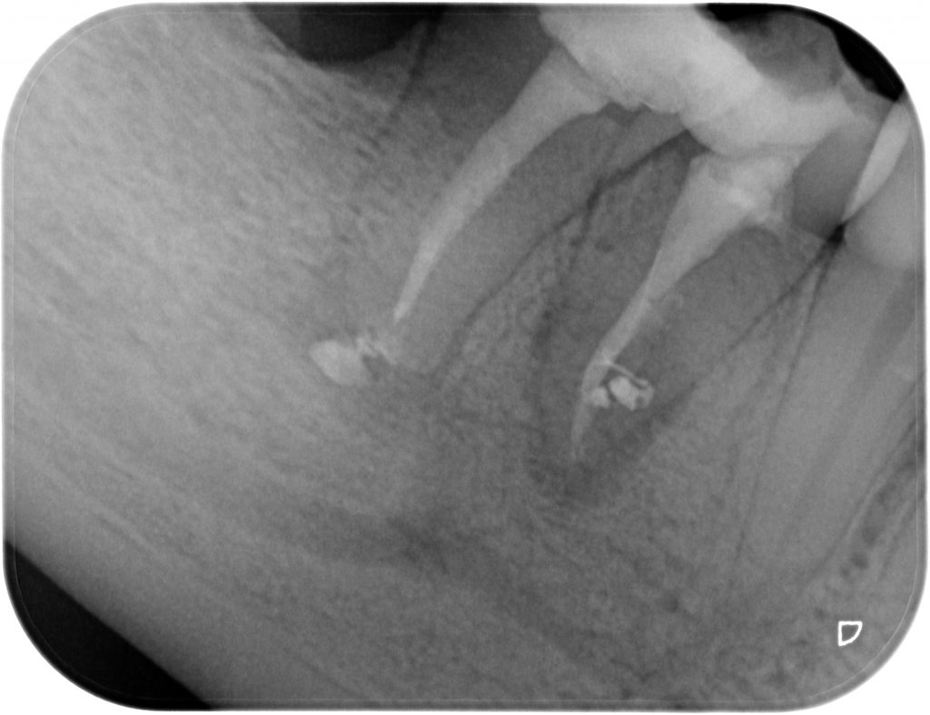 Caso clínico 2 de endodoncia - RX final 1