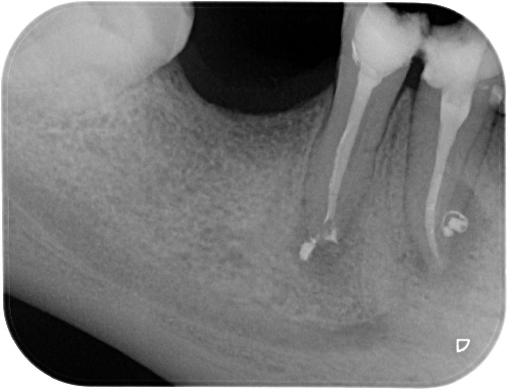 Caso clínico 2 de endodoncia - RX final 2
